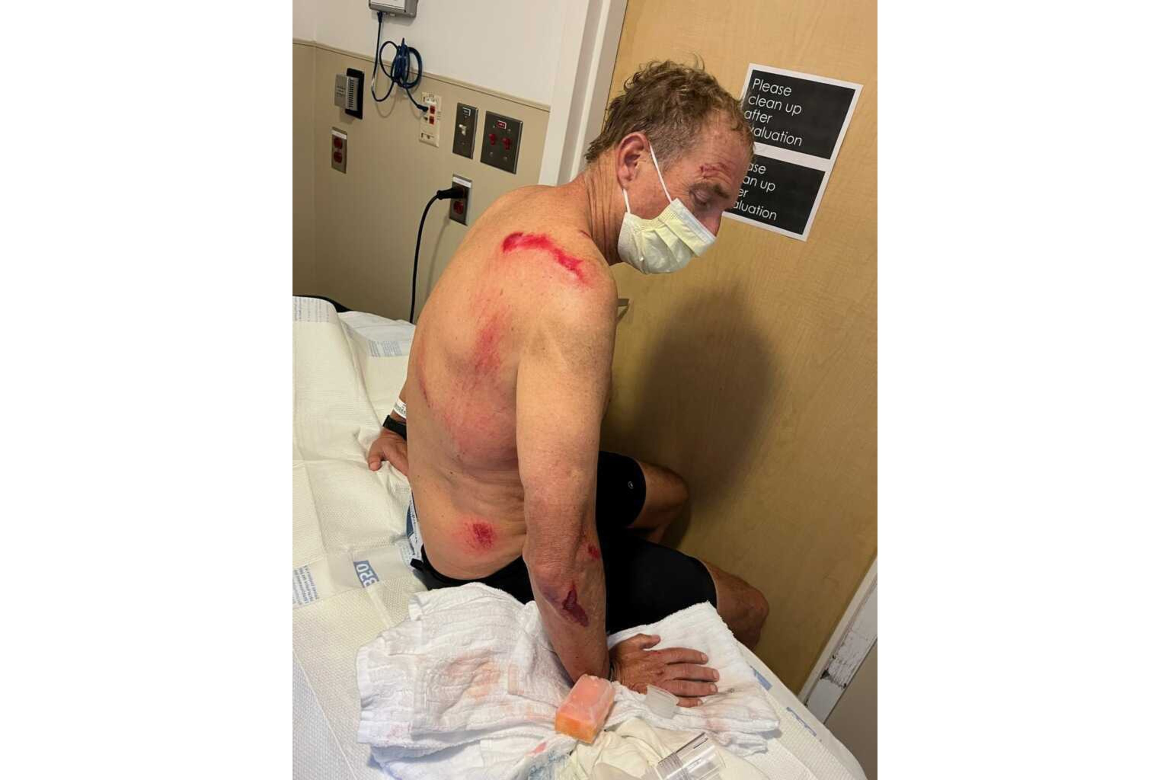 A shirtless man in a hospital, showing his bruised side and back. He wears a mask and sits on the bed.