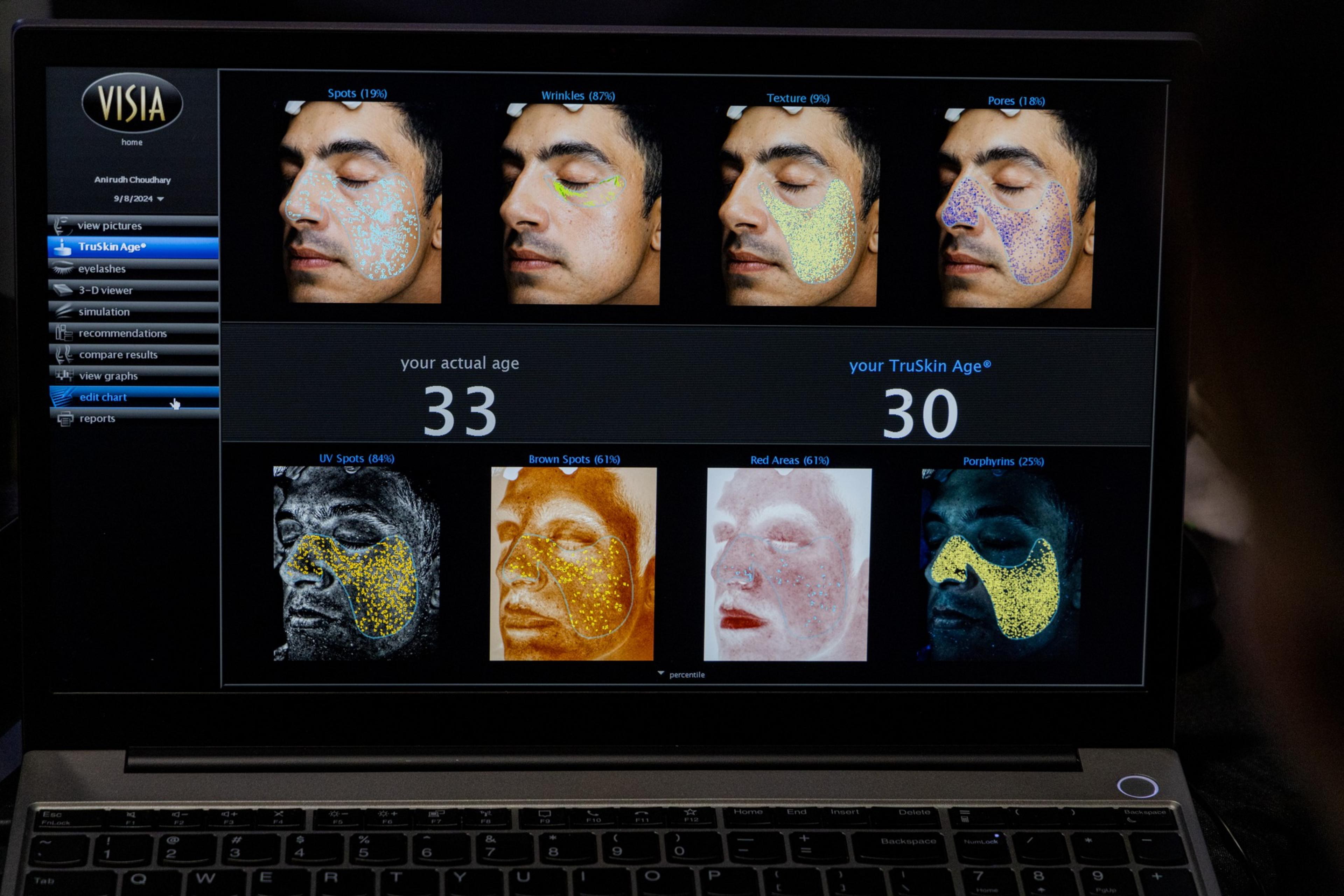 A computer screen displays skin analysis results with facial images highlighting spots, wrinkles, texture, pores, UV spots, brown spots, red areas, and porphyrins. It shows an actual age of 33 and a TruSkin age of 30.