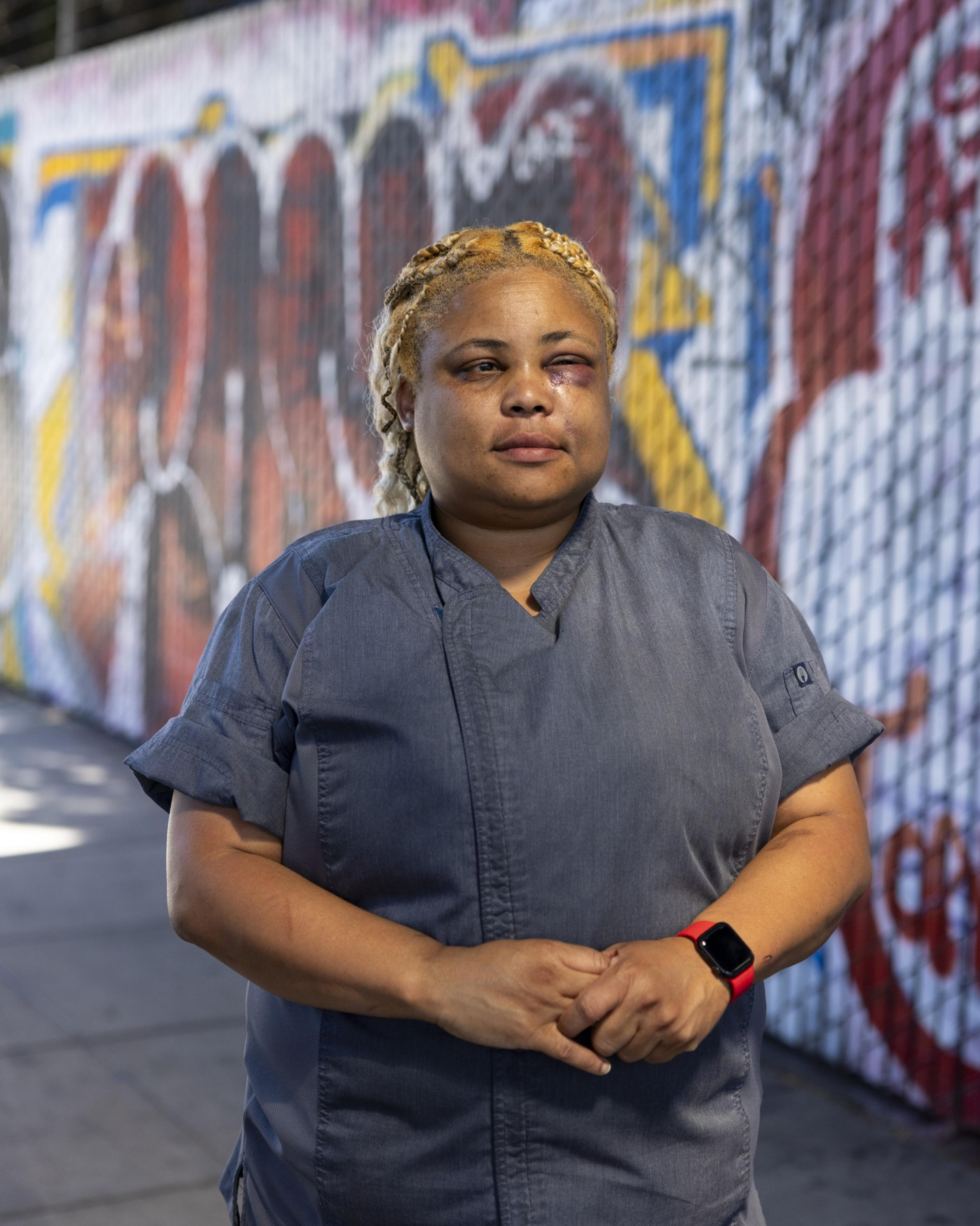 A person with braided hair and a facial bruise stands in front of a colorful graffiti-covered fence, wearing a gray short-sleeve shirt and a red watch.