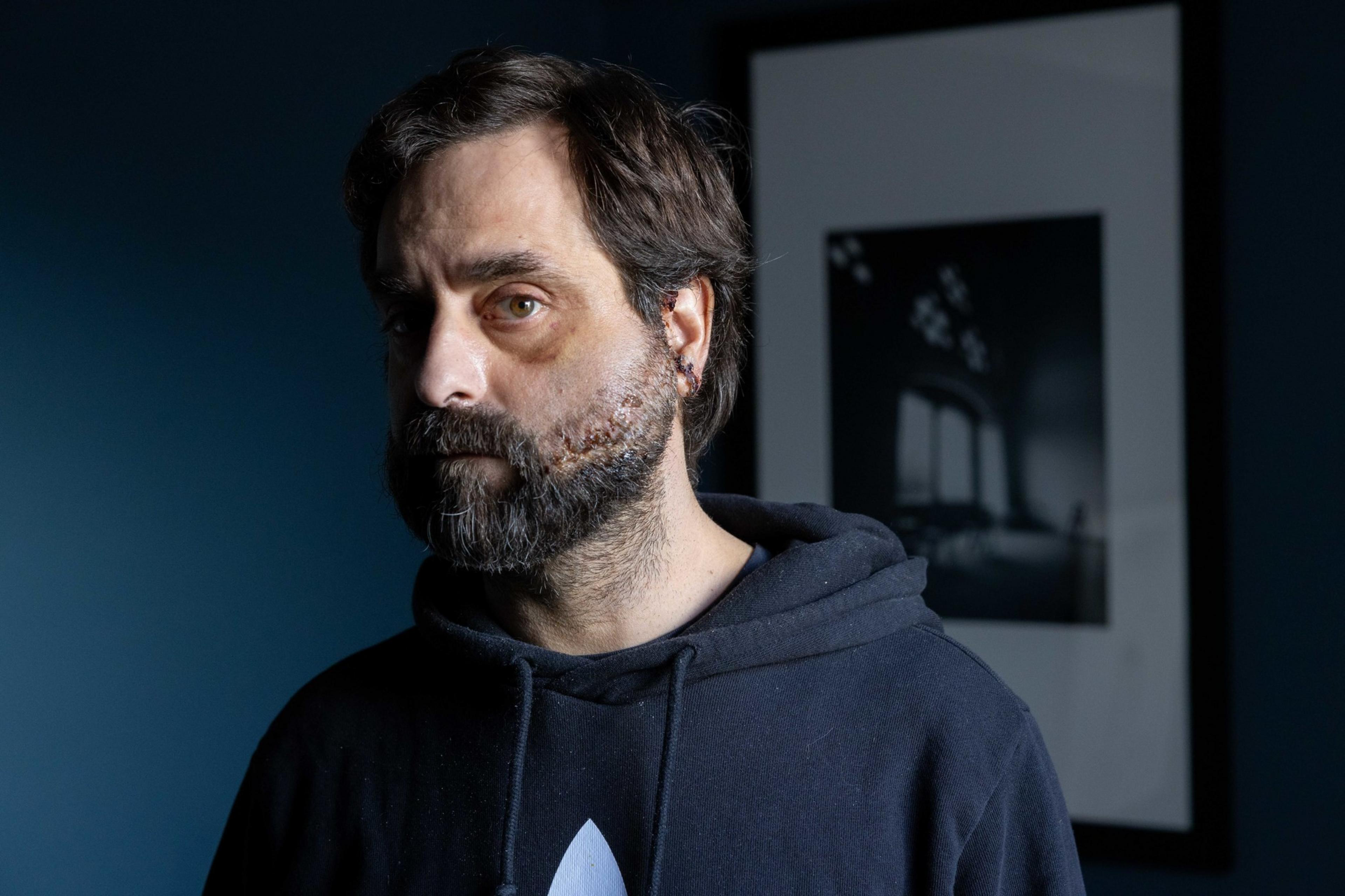 A man with a beard and a bruised eye stands in front of a dark blue wall, wearing a black hoodie. A framed black and white photo hangs on the wall.
