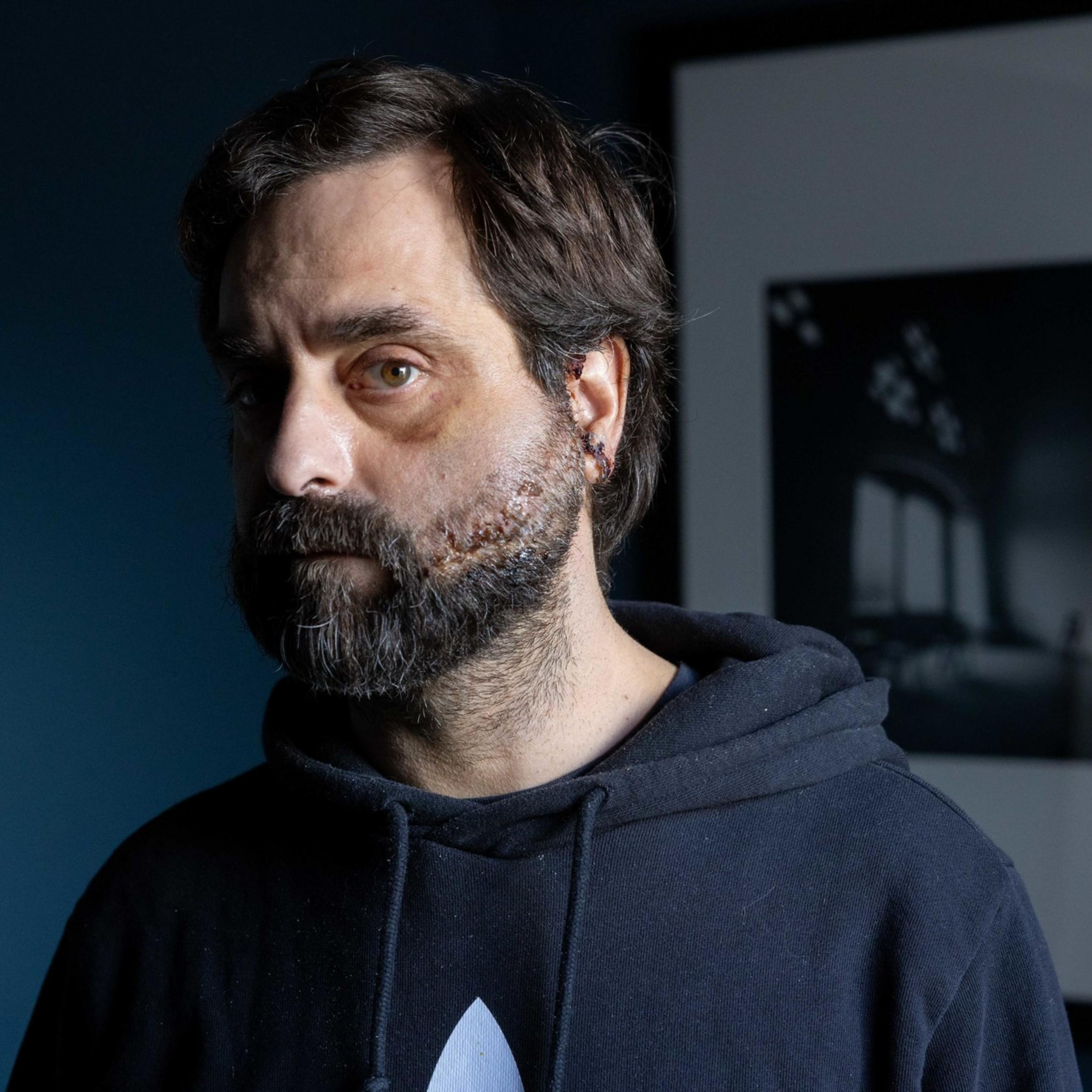 A man with a beard and a bruised eye stands in front of a dark blue wall, wearing a black hoodie. A framed black and white photo hangs on the wall.