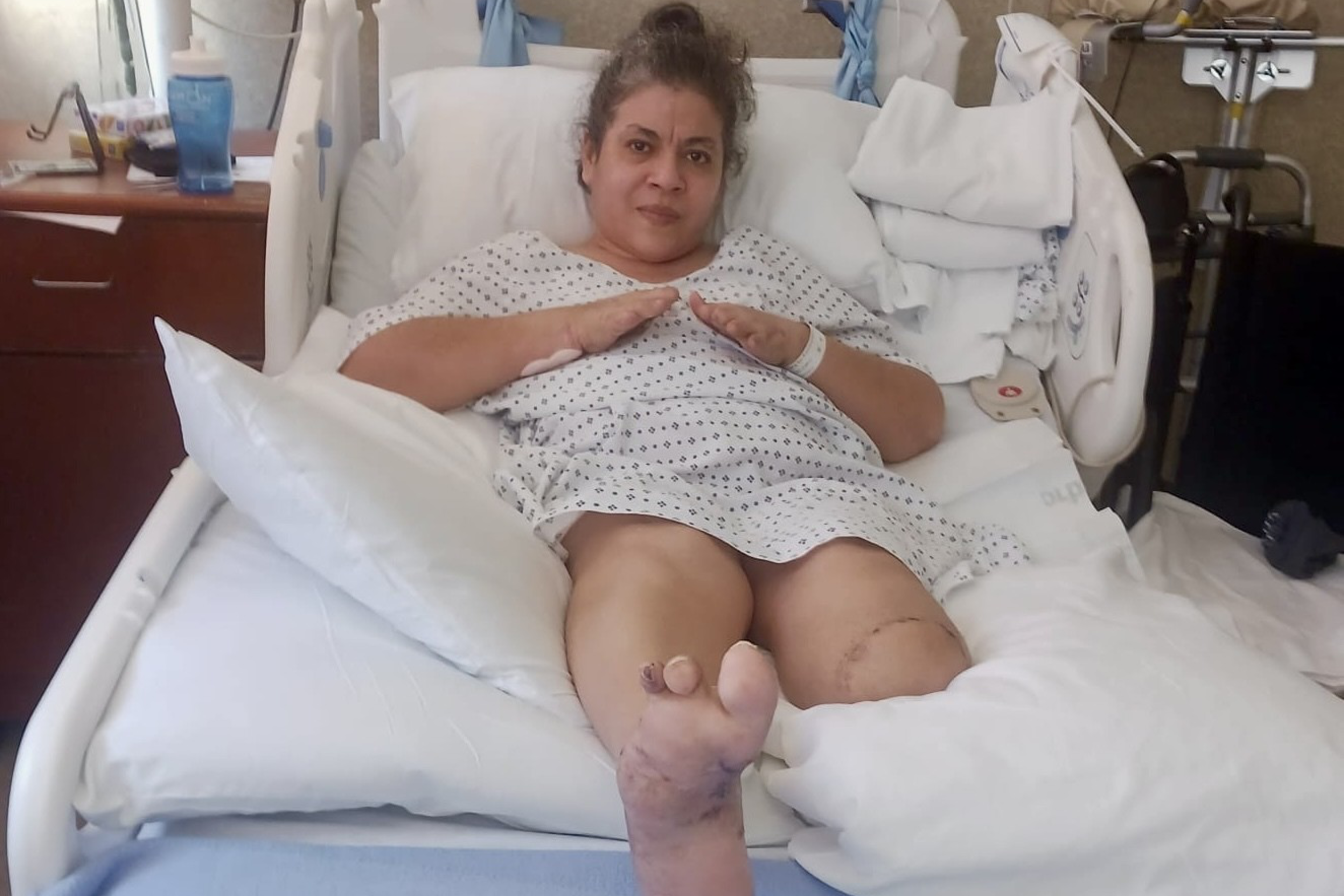 A woman in a hospital bed wearing a gown has her right leg bandaged and elevated on pillows. She appears to be resting, with folded hands on her chest.