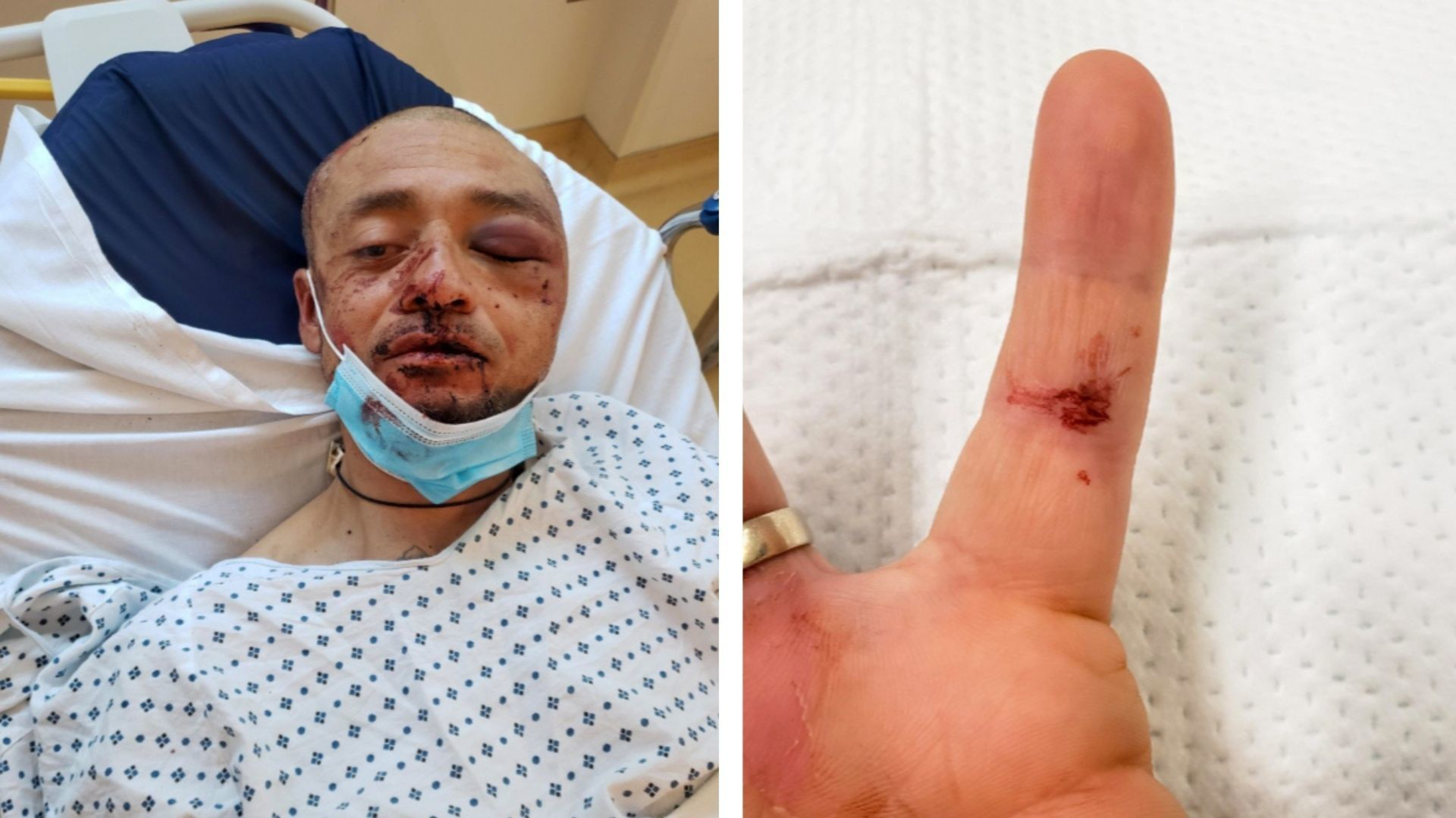 A man with facial bruises and a bandaged head lies in a hospital bed, wearing a hospital gown and a lowered surgical mask, while a close-up shows a cut on his thumb.