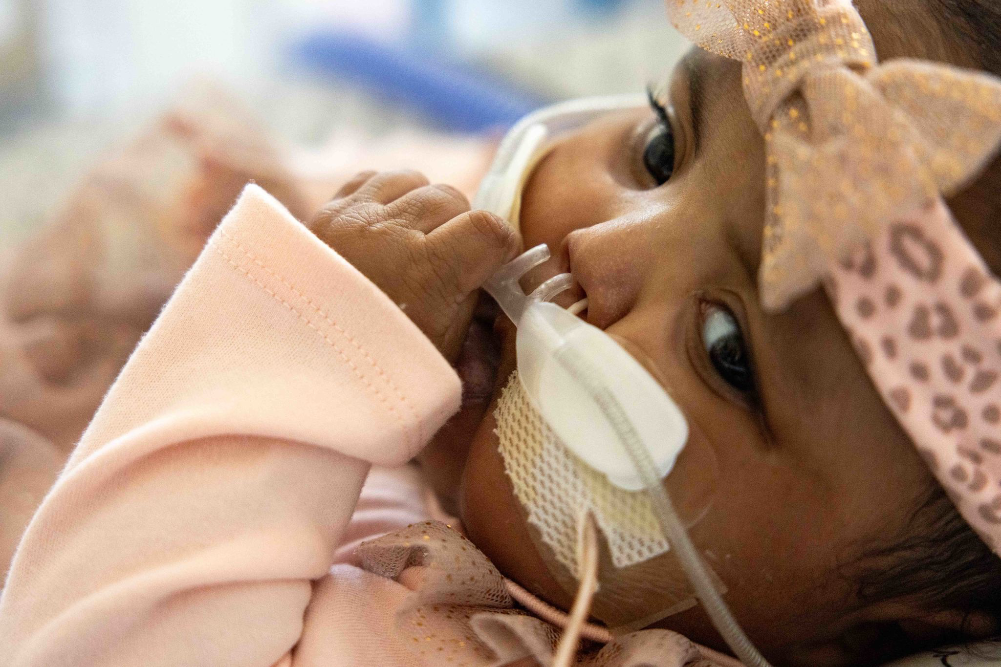 A baby with a nasal feeding tube lies down, wearing a light pink outfit and a sparkly leopard print headband with a bow.