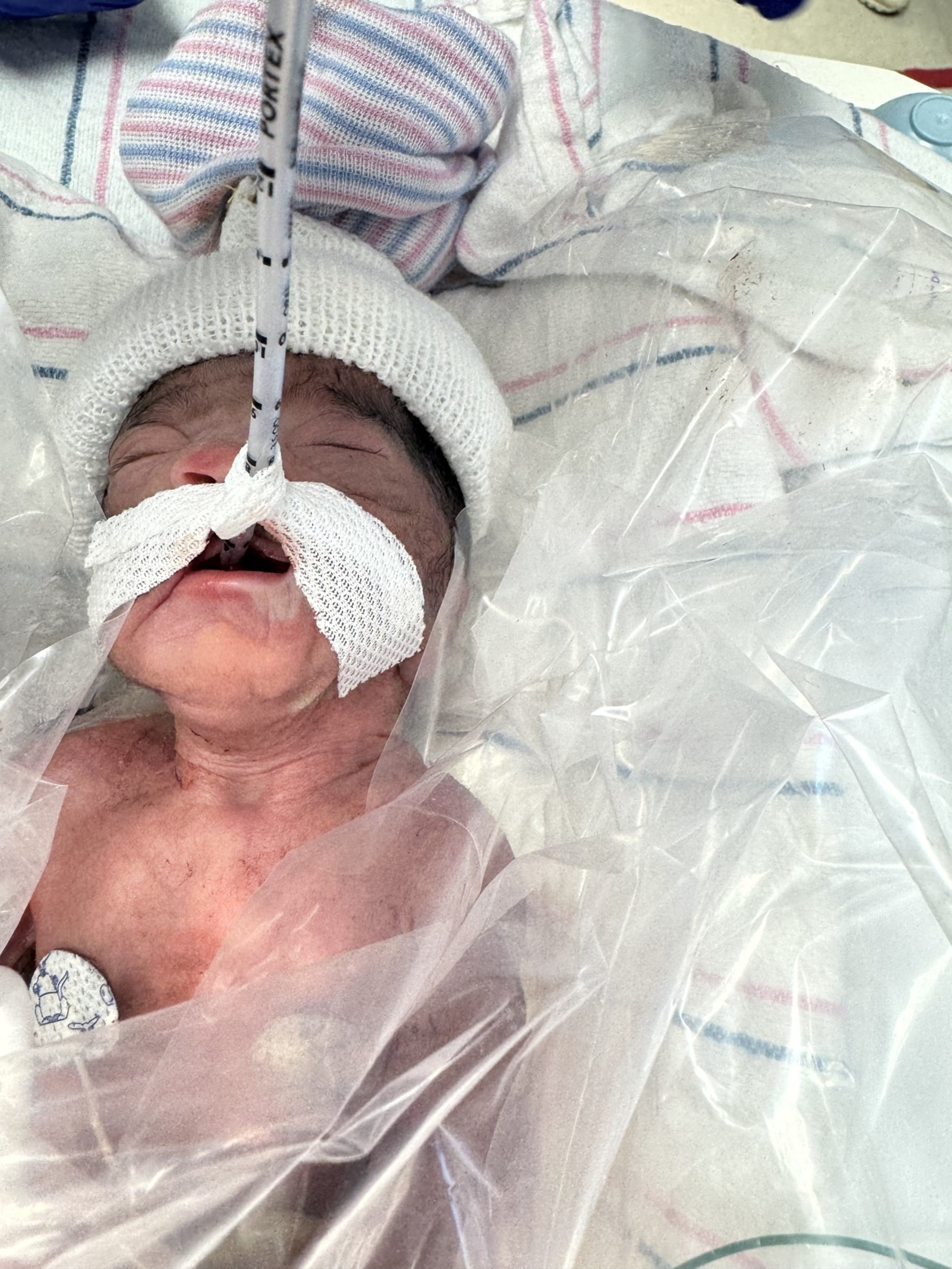 A newborn baby with a white knitted hat is lying under a clear plastic cover, with a tube taped to their mouth for breathing assistance.