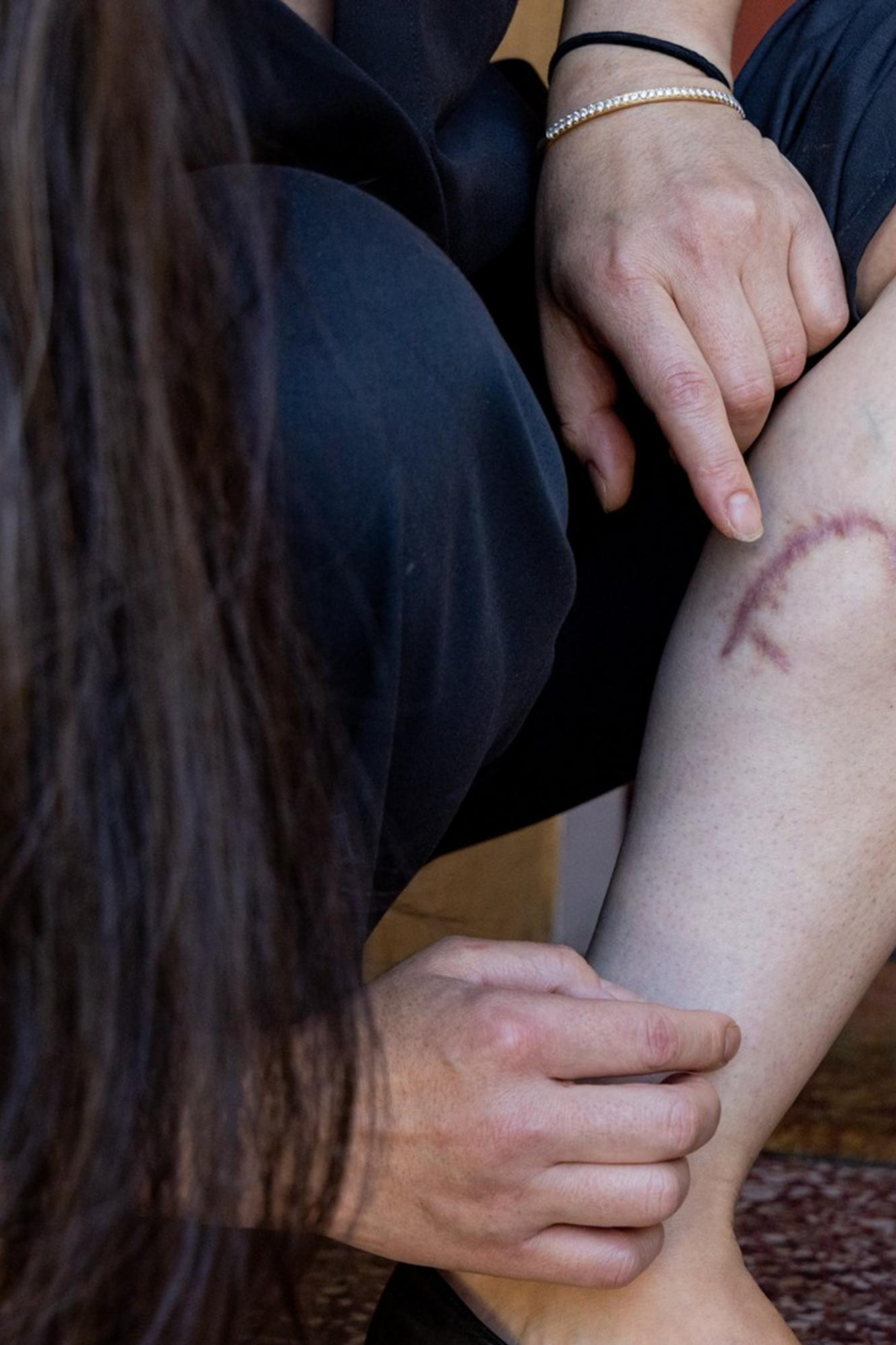 A person is crouched, pointing at a circular, reddish scar on their lower leg. They are wearing black pants and black shoes with a metallic heel detail.